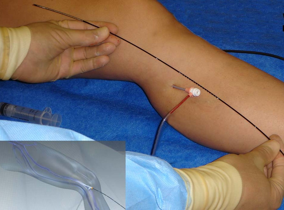 Radiofrequency Ablation